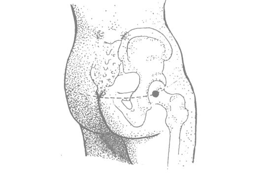 https://acupuncture.rhizome.net.nz/media/cms_page_media/104/buttock.gif